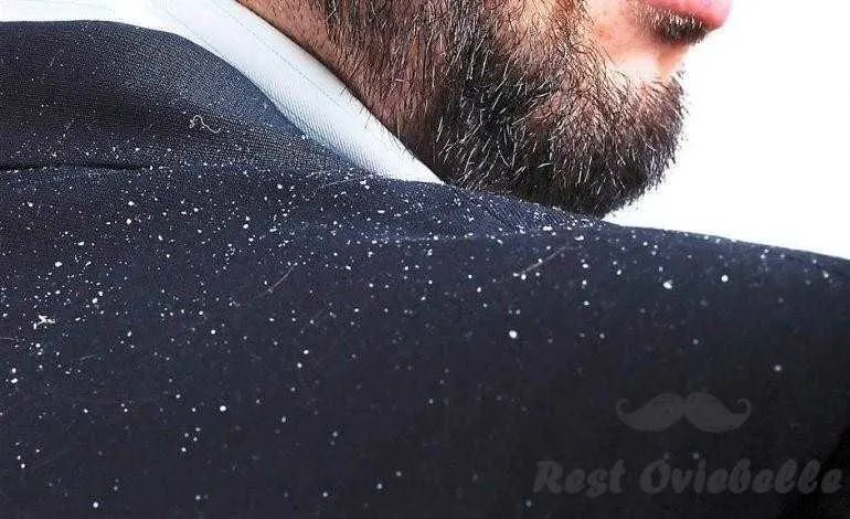 The Primary Cause For Dandruff - Best Dandruff Shampoos For Men