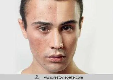 best acne treatments for men