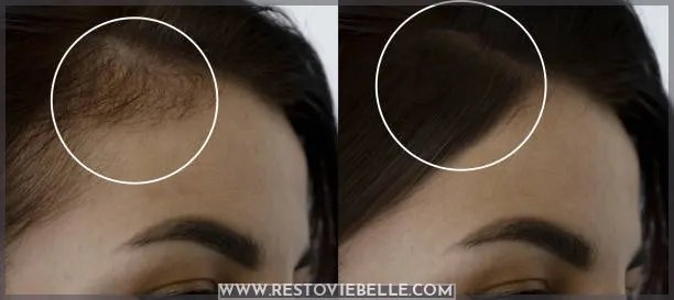 Woman head baldness before and after treatment