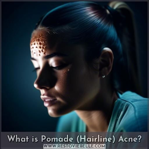 What is Pomade (Hairline) Acne