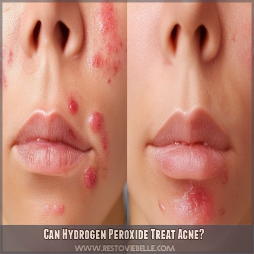 Can Hydrogen Peroxide Treat Acne Can Hydrogen Peroxide Treat Acne