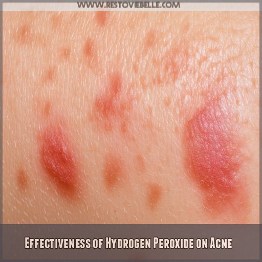 Effectiveness of Hydrogen Peroxide on Acne Effectiveness of Hydrogen Peroxide on Acne
