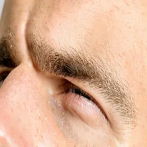 Hair Loss Causes Explained