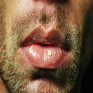Healthy Lip Care